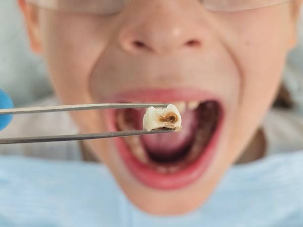 Best Pediatric Emergency Dentist in Weatherford, TX